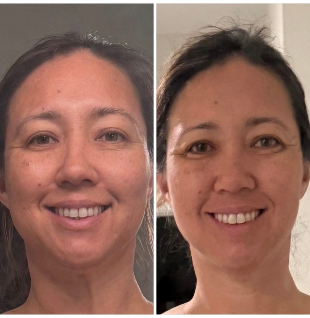 Side by side comparison of face after seven days of 75 Hard Challenge